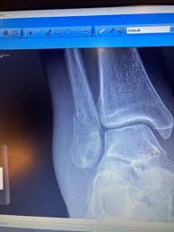 Image result for Ankle XRay