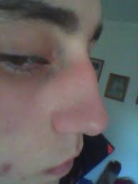 How do i know if my nose is broken? A Few Months Ago I Broke My Nose And Now It Is Deformed What To Do Photos