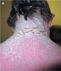 Image result for scabies on genitals