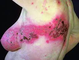 Herpes Zoster Doencas Infecciosas Manuais Msd Edicao Para Profissionais