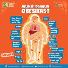 Sudah Masuk Obesitas Blom Ya Kesehatan Diabetes Melitus Tipe 2 Diet