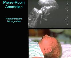 Pierre Robin Anomalad Syndrome