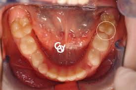 For most men, glasses are just functional daily necessities. Mih Or Hypomineralization Of Incisors And Molars Dentisti Vignato Vicenza