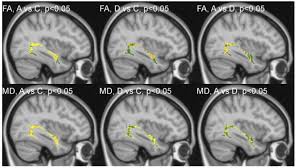 In this hospital department of neurology, and orthopedics are present. Diffusion Tensor Imaging And Tractography In Autistic Dysphasic And Ndt