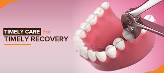 Check spelling or type a new query. Tooth Extraction Aftercare Do S And Don Ts Clove Dental