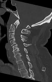 Differences in Cervical Spine Fractures in Patients Younger or Older Than  65 Years of Age: Implications for the Canadian C-Spine Rule | American  Journal of Neuroradiology