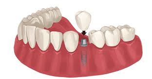 What are some alternative treatments to dental implants? Same Day Dental Implant Immediate One Day Cost Best Costa Mesa Ca California Dentistry At Its Finest