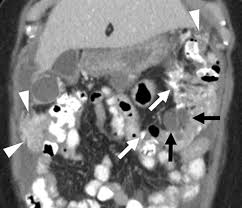 Image result for CT Intravenous Contrast