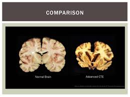 I wonder if oprah asked michael jackson what cte on his shoulders meant when she interviewed him in 1993? Cte Presentation Tara