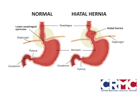 Image result for stomach hernia symptoms