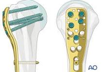 ORIF - Plate fixation (proximal 1/3) for Multifragmentary ...