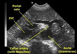 Aorta Sonography Medicina Nemoci Studium Na 1 Lf Uk Diagnostic Medical Sonography Sonography Ultrasound