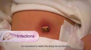 Caring For Your Baby S Umbilical Cord Stump Is One Of The Most Important Things You Need To Do Correctly An Newborn Care Baby Umbilical Cord New Baby Products