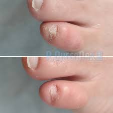 足の小指の爪がない問題も大丈夫☆ | 爪をきれいにしたい人のためのネイルサロンR.QueenNail＜西千葉みどり台＞