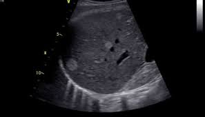 Adenomyomatosis is one of the hyperplastic cholecystoses. Quizz Vesicule Biliaire Echo Urgences