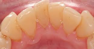 Eliminez Le Tartre Sur Vos Dents Sans Avoir A Payer Pour Une Visite Chez Le Dentiste Sante Bucco Dentaire Detartrage Dents Tartre Dentaire
