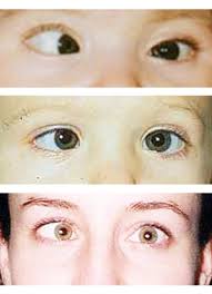 Image result for Strabismus