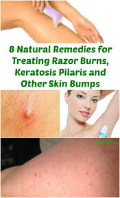 8 Natural Remedies For Treating Razor Burns Keratosis Pilaris And Other Skin Bumps Skin Bumps Beauty Care Beauty Remedies