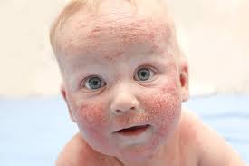 Eczema In Babies & Children
