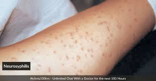 Image result for Neurosyphilis