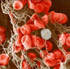 In astrazeneca vaccine recipients affected by this rare clotting syndrome, the number of platelets drops. Studies Suggest Link Between Blood Clots Astrazeneca Covid Vaccine Cidrap