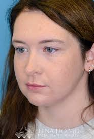 Image result for Webbed Neck