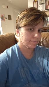 I've been in the hospital and was glad the doctors knew about  Neurofibromatosis. Some staff did ask about my bumps and I told them I have  NF1.