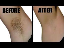 This system of hair removal is permanent and very expensive. In Just 5 Minutes Remove Unwanted Hair Permanently No Shave No Wax Ll Ngworld Youtube Remove Armpit Hair Underarm Hair Hair Removal Diy