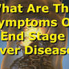 The last stage of liver cancer has the symptoms like severe pain, wasting and suffering. 1