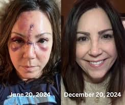 In the early evening six months ago today, a microburst blasted through an  outdoor concert I was working and threw me 30-40 feet, along with our  station tent. The tent hit me