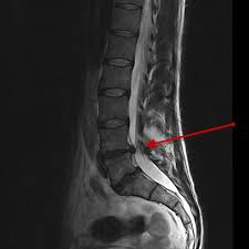 Image result for vyhřezlá ploténka