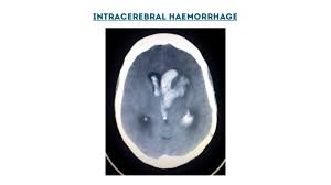Ct Head Interpretation Radiology Geeky Medics
