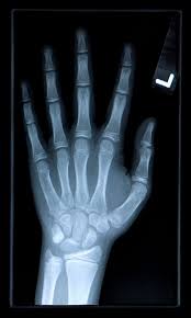 Image result for Scapholunate Dislocation