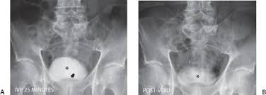 Image result for Intravenous Pyelogram