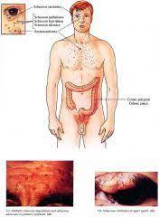 9 Muir Torre Syndrome Ideas Syndrome Muir Cancer