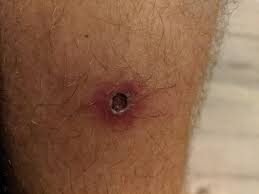 In men, ingrown hair may occur in the cheeks, the chin and more often in the neck. Any Ideas On How To Heal An Infected Ingrown Hair Thing Is On My Thigh And I Want It Gone Ingrownhairs