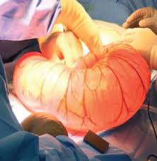 Image result for Megacolon