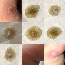 What causes common skin warts? I Pulled Off My Plantar Wart On The Side Of My Big Toe Below Shows The Before The Top And Bottom Sides Of The Wart Itself And Then The After I Ve Been