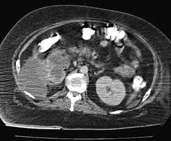 Image result for Perinephric Abscess