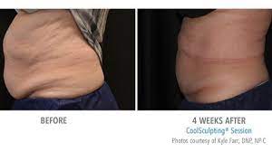 Coolsculpting® and coolsculpting® elite may cause a visible enlargement in the treated area, which may develop 2 to 5 months after treatment and requires surgical intervention for correction. Coolsculpting Before And After Real Patient Photos Vein And Laser Institute