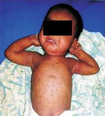 Image result for scabies human children