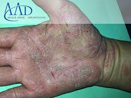 Image result for dermatitis contacta