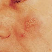 But skin cancers can look different from these examples. Herpes On Face Cheek Pain Wzmv Tyrinpizza Ru
