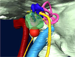 Image result for Glomus tumor