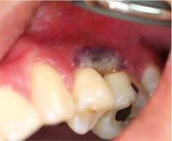 La mucormicosis cutánea primaria es una infección micótica rara que se asocia a estados de inmunosupresión. Successful Treatment Of Periodontal Mucormycosis Report Of A Case And Literature Review Oral Surgery Oral Medicine Oral Pathology Oral Radiology And Endodontics