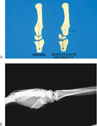 Image result for Lunate Dislocation