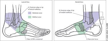 Acute Ankle Sprain An Update American Family Physician