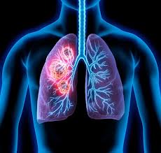 A cough that doesn't go away or gets worse over time Non Smokers With Lung Cancer Likely To Respond Differently To Treatment Docwire News