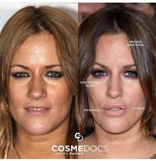 Caroline Flack Atozplasticsurgery In 2020 Caroline Flack Caroline Flack Style Types Of Plastic Surgery