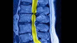 Spinalkanalstenose Ursachen Symptome Diagnostik Schon Klinik